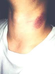 See full list on wikihow.com 5 Clever Effective Hacks To Hide Hickeys In The Summer So Your Mother Never Finds Out