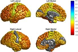 Not all individuals with the same diagnosis show the same type of brain abnormalities. Cortical Abnormalities In Bipolar Disorder An Mri Analysis Of 6503 Individuals From The Enigma Bipolar Disorder Working Group Molecular Psychiatry