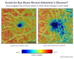 Octa senior research fellow dr. Alzheimer S Disease Signs Detected By Noninvasive Eye Scan