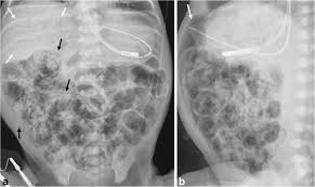 Image result for Necrotizing Enterocolitis