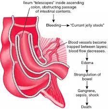 Image result for Intussusception