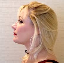 Plastic Surgery in Santa Barbara Ventura Montecito CA