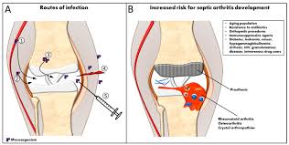 Image result for Septic Joint