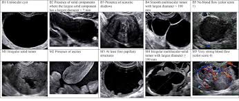 Transvaginal and color doppler ultrasonograms of stage i ovarian cancer. Ovarian Mass Differentiating Benign From Malignant The Value Of The International Ovarian Tumor Analysis Ultrasound Rules American Journal Of Obstetrics Gynecology