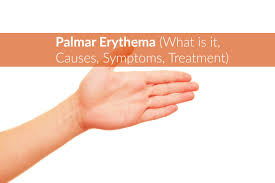 Palmar erythema may be found in up to 60% of people with rheumatoid arthritis. Palmar Erythema What Is It Causes Symptoms Treatment The Healthy Apron