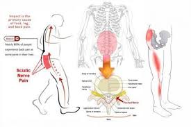 Pin On Pinched Nerve In Lower Back