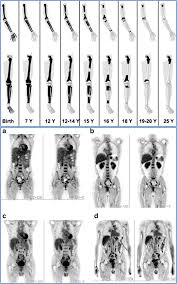Domestic and foreign oncologists point out the following main clinical symptoms of bone marrow. Cancer Metastasizes To The Bone Marrow And Not To The Bone Time For A Paradigm Shift Springerlink