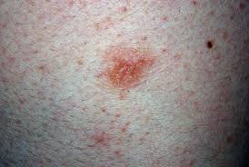 However, unexplained recalcitrant eczema may be associated with an underlying lymphoproliferative malignancy. Nummular Dermatitis Nummular Eczema Dermatology Advisor
