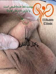 عکس بیماری پوستی دستگاه تناسلی - کلینیک اورولوژی الهام (یادمان کلینیک)