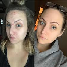 QUESTION/ADVICE So I started working at a dairy farm 4 months ago and I am  starting to notice I am getting acne. I never really had it before even as  a teenager.