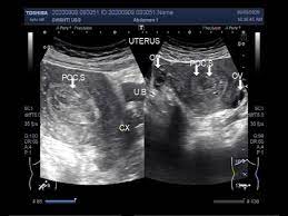 Ultrasound in the detection of rpoc, but 15 women. Ultrasound Video Showing Retained Products Of Conception Rpoc After D C Youtube