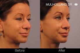 Typically i would perform a careful examination of the patient to determine the exact structural causes that contribute to the nose's bulb shape and how to get rid of turkey neck for good april 09, 2021. Rhinoplasty For Bulbous Nose Tip Causes Treatment