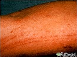 Image result for Linear Dermatitis