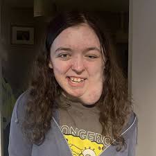 Girl, 14, has 'mole' misdiagnosed three times before devastating condition  confirmed