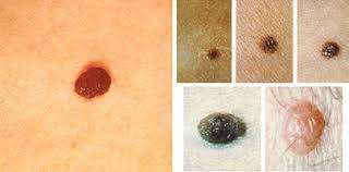 Chemotherapy and immunotherapy can also change the color, or pigment, of the skin, but it&#x27;s less common. Recognize Skin Cancer Know Your Abcde S Community Health Network