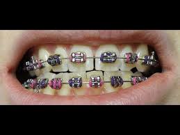 Maybe you would like to learn more about one of these? Dressing Up With Fake Braces Youtube