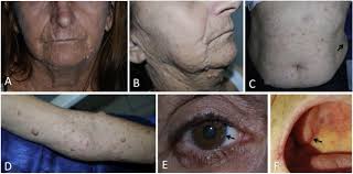 Neurofibromatosis (nf) is nervous system disease that causes skin defects and tumors on nerve tissues. Exuberant Manifestation Of Neurofibromatosis Type 1 Affecting 3 Generations Delayed Diagnosis And The Importance Of The Multidisciplinary Approach Oral Surgery Oral Medicine Oral Pathology And Oral Radiology