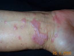 Lichen planus and lichenoid dermatoses: Lichen Planus Dermatly Com Ihre Hautseite