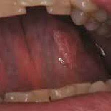 Lepas tu, mulalah dia meragam dan tak mahu makan. Oral Papilloma Squamous Cell Papilloma Of The Oral Mucosa Hpv Download Scientific Diagram