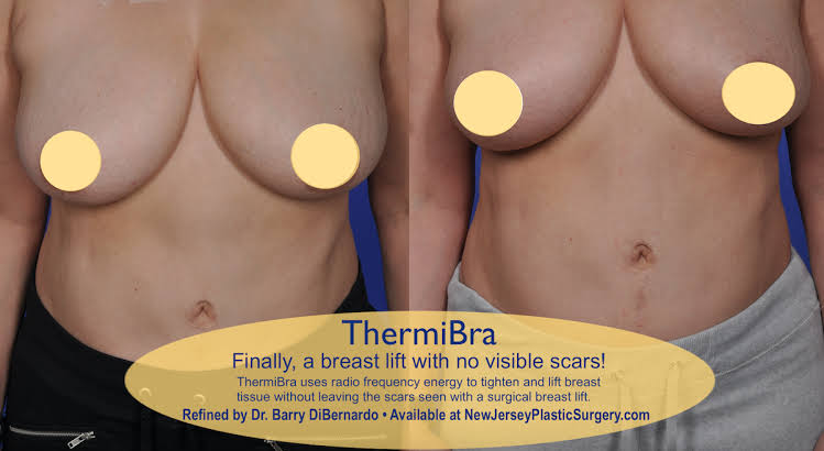 saggy breast before and after non surgical breast lift