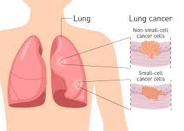 S what does that mean? Lung Cancer The Facts Get Healthy Stay Healthy