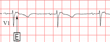 Image result for Epsilon Wave