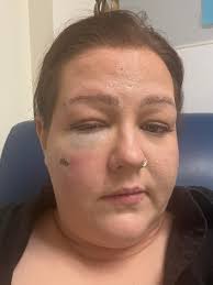 Severe bruising from a workplace accident