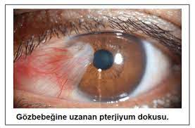 pinguekula ve pterjiyum prof dr gokhan gulkilik