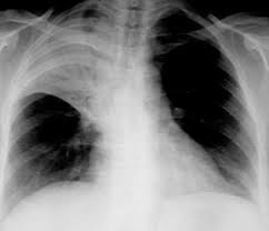 Image result for Air Bronchogram