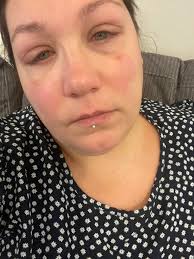 Sad to be missing Leann McCormick Wente's challenge class again but still  feeling pretty rundown from bronchitis. Forgot how bad it can get you down.  On a good note, after having eye