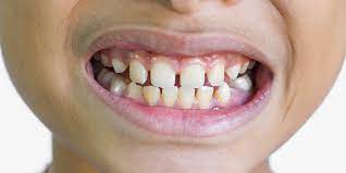 Thank u so much for watching! Closing Gaps In Teeth Without Braces Cosmetic Dentist Dr Alex Midtown Nyc