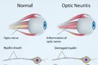 Optic Neuritis | Neurology, General Medicine & Diabetes Specialist ...