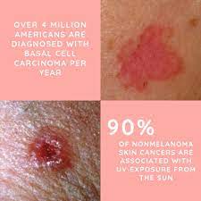 Victoria sharon explains how to look for the most common signs of skin cancer, also known as th. Dr Dray New Skincare Video Is Up On My Youtube Channel All About The Most Common Skin Cancer Basal Cell Carcinoma Bcc Bcc Is The Most Frequently Occurring Form Of All
