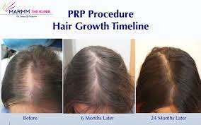 Haircuts for a receding hairline. Receding Hairline What Can Be Your Treatment Options By Marmm Klinik Medium