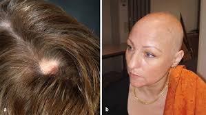 Alopecia areata affects men and women equally, and it can occur in people of any ethnic … Figure 1 Genetik Der Alopecia Areata Springerlink