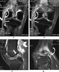The main knee muscles are the quadriceps, hamstrings and calf muscles. Mri Of The Posterolateral Corner Of The Knee Please Have A Look Sciencedirect
