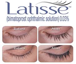 Latisse is an eyelash enhancing product that is intended to make lashes look longer, thicker, and darker over a period of time. Latisse Palm Springs Eyelid Surgery