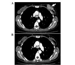 A ct scan can show whether breast cancer has spread to the lungs or liver. A Chest Ct Scan Of A 36 Year Old Female Showed Left Sided Breast Download Scientific Diagram