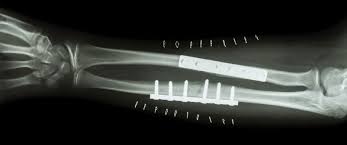 Image result for Fracture Types