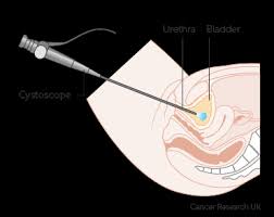 How do people know they have cancer? Trans Urethral Resection Of Bladder Tumour Turbt Bladder Cancer Cancer Research Uk
