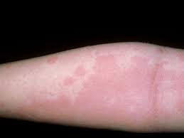 Photos And Symptoms Of Common Food Allergy Symptoms