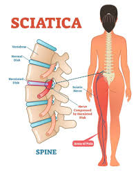 Va Rating For Sciatica How To File A Va Claim For Sciatica