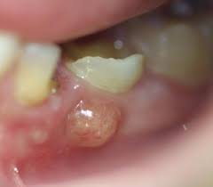 I have a gum boil at the side of a root canaled tooth for some time now. Dental Abscess Wikipedia