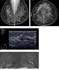 S what does that mean? Screening Mri Benefits Women At Average Risk Of Breast Cancer Imaging Technology News