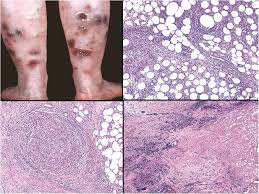 Image result for Panniculitis