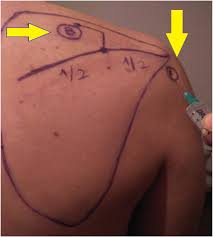 Image result for Subacromial Space Injection