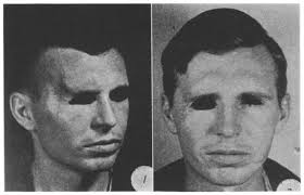 USE OF TANTALUM FOR FACIAL AND CRANIAL DEFECTS