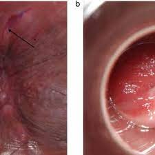 After that, anything can happen. 17 Year Old Boy Examined Acutely Due To A History Of Anal Penetration Download Scientific Diagram
