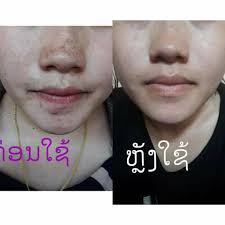 ບີແມຊ່ວຍໄດ້ໃຫ້ຫລາຍໆຄົນດີແລ້ວ ບີແມ ຊ່ວຍລົດສີວ,ລົດຟ້າ,ລົດຈຸດດ່າງດຳ  ສາມາດຊ່ວຍໃຫ້ຜີວຂາວໃສໄດ້ ມີພ້ອມສົ່ງເດີຢູ່ໂນນໄຮ Beme pab tau coob2 leej zoo  lawm poj ...