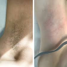 As long as you eat a healthy diet of protein, carbohydrates, including fruit, and vegetables, at least you will not slow. Thick Dark Underarm Hair